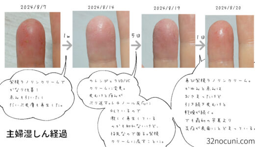 カレンデュラオイルでレチノール反応？　指が再び皮むけに